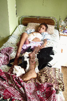 Boy With Badly Damaged Leg